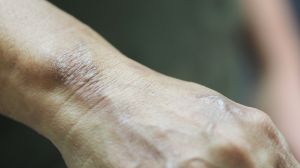 Leprosy cases are surging in central Florida. The CDC is warning the disease is becoming endemic in the southeastern United States. 